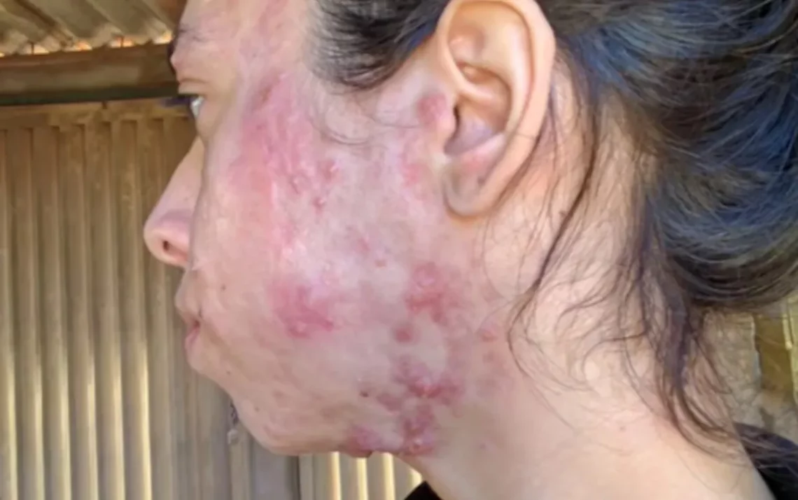 espinha, cravo, cicatriz de acne