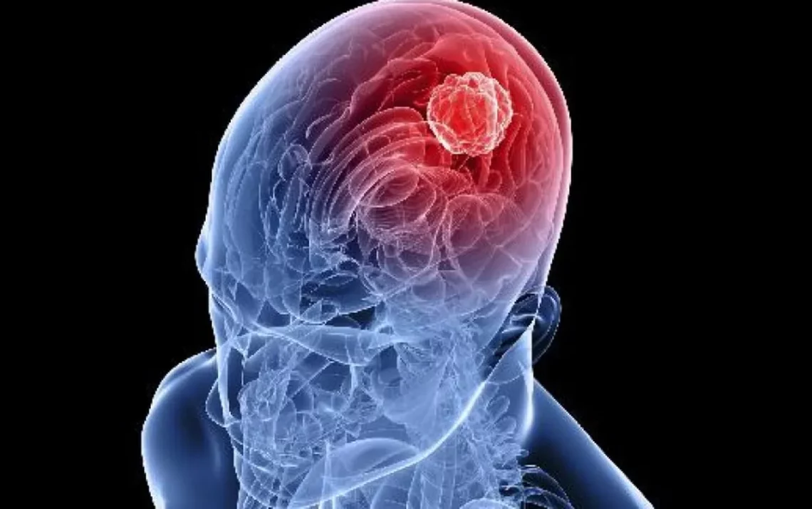 GLIOBLASTOMA: Em menos de 48 horas após a administração da vacina, houve mudanças significativas nas configurações dos tumores (Thinkstock/VEJA/VEJA) - Todos os direitos: @ Veja Abril