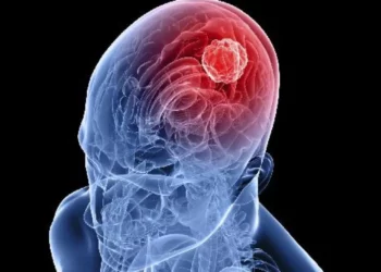 GLIOBLASTOMA: Em menos de 48 horas após a administração da vacina, houve mudanças significativas nas configurações dos tumores (Thinkstock/VEJA/VEJA) - Todos os direitos: @ Veja Abril